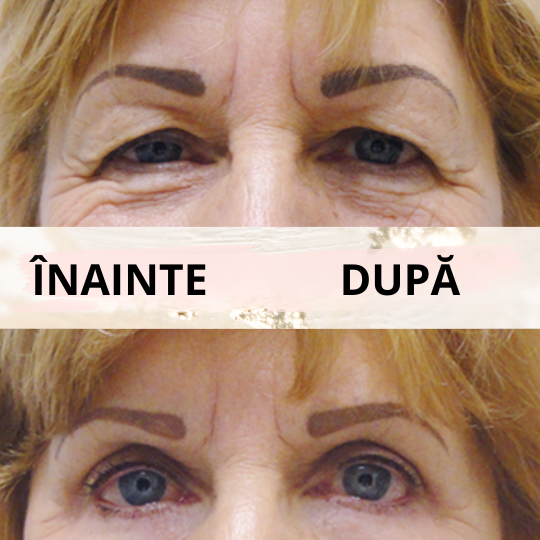 Eyelid PushUp™ 🤩 Privire Instantanee ✨ 120 Perechi! 😱