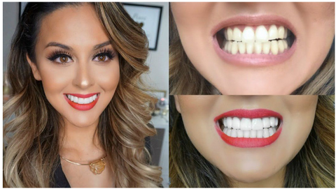 Zâmbet perfect instantaneu cu Snap-On Smile – Facete dentare ușor de aplicat!