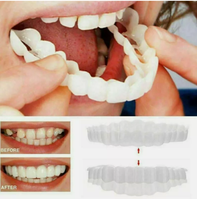 Zâmbet perfect instantaneu cu Snap-On Smile – Facete dentare ușor de aplicat!