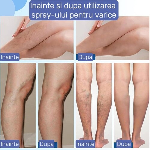 VenoRelief™ - alinare imediată pentru picioare