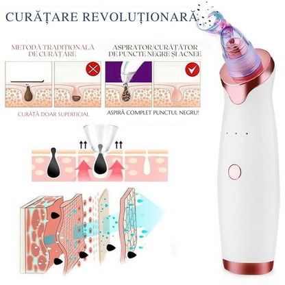 Extractor de acnee™ – Curățare Eficientă și Fără Durere