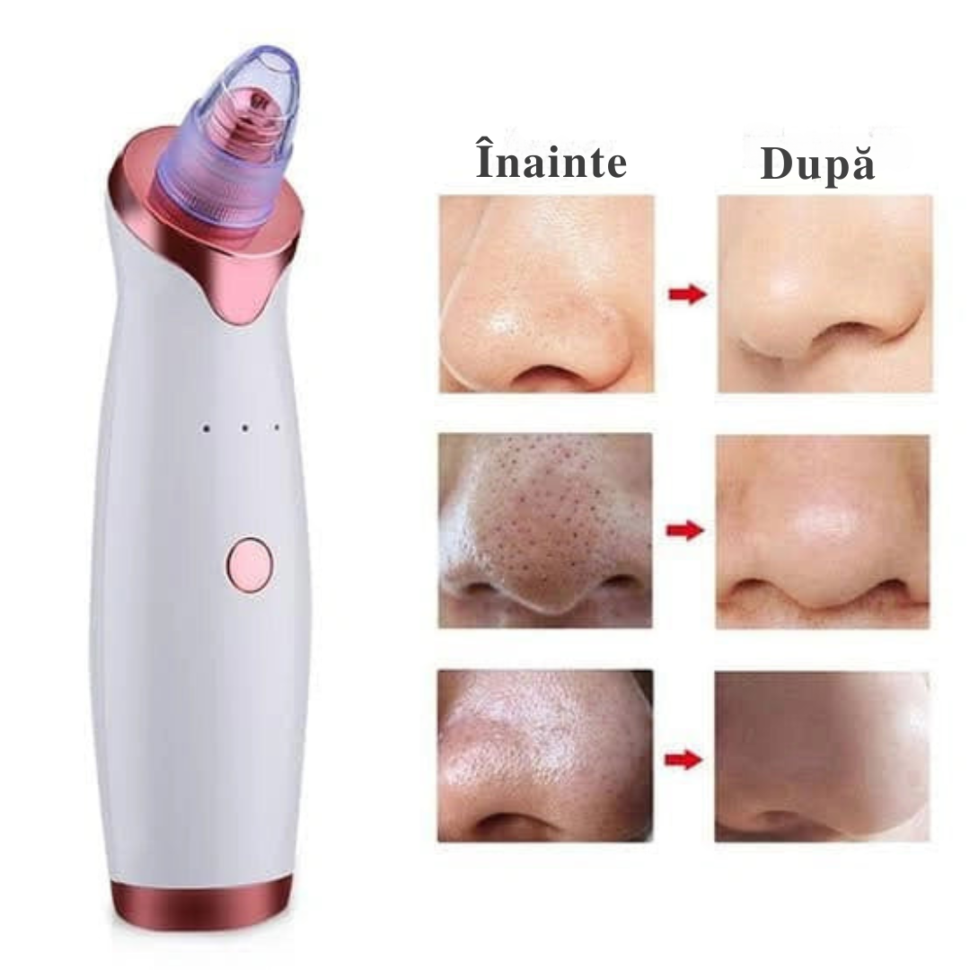Extractor de acnee™ – Curățare Eficientă și Fără Durere