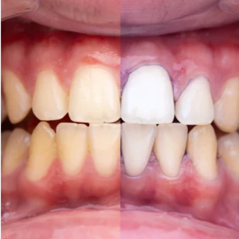 GlumiWhite™ – V34 Albire – [OFERTĂ VALABILĂ DOAR ASTĂZI]